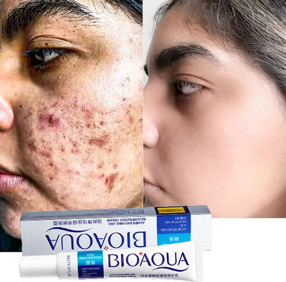 Bioaqua Acne Removing & Rejuvenating Cream - 30g Hot on Sale